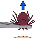 tick-removal2